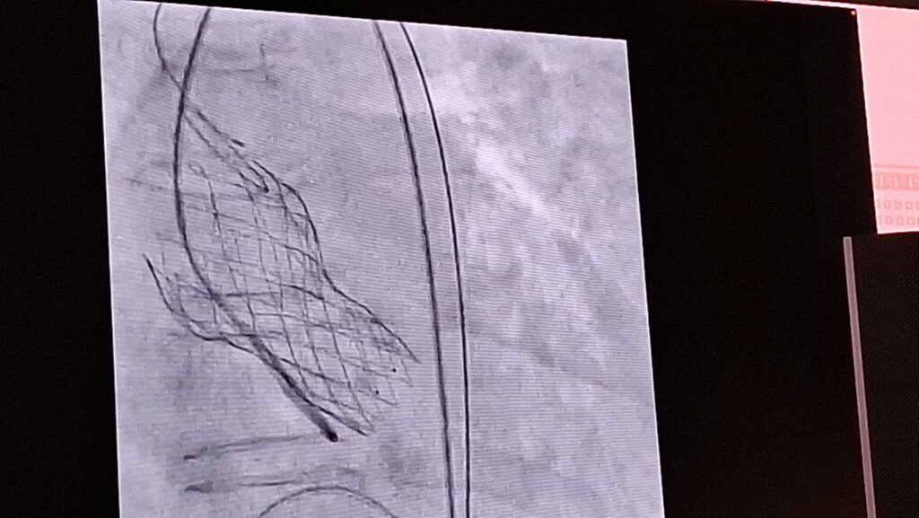 P&F product presentation at the Structural Heart Summit Mumbai 2025