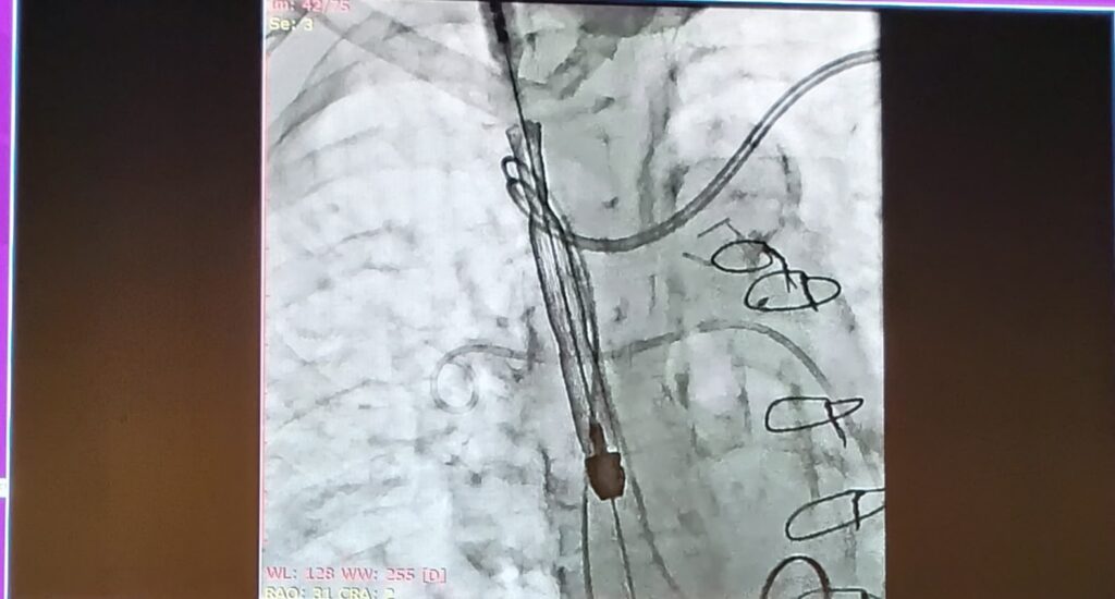 Surgical image from presentation at PCR Rio Valves 2025