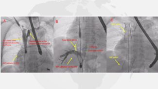 imaging of tricvalve® implantation