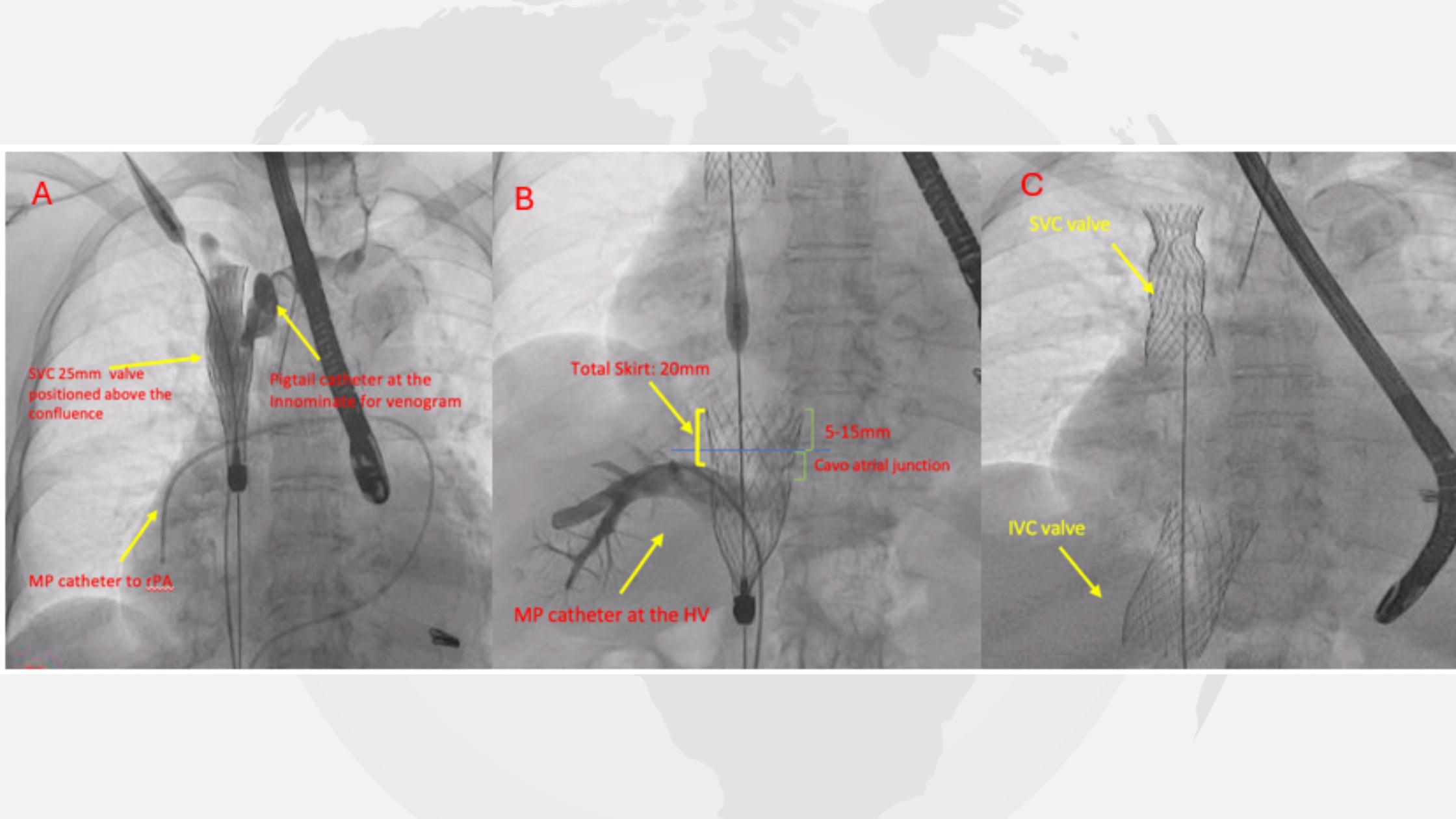 imaging of tricvalve® implantation